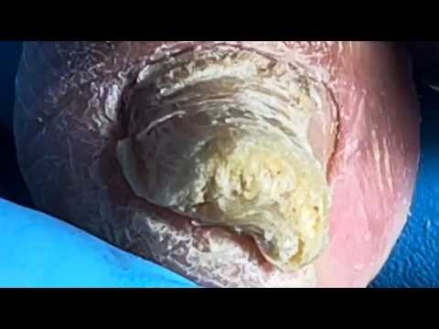 Dirty Toenails, 90 Year Old Man Doesn't Pay Attention To Hygiene【Pedicure Master Lin Jun】