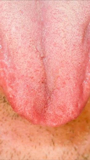 After Kevin’s AGONIZING tongue biopsy, his swollen, tortured tongue made it so difficult for him to speak that his pharmacist was unable to understand him when he desperately tried to pick up his prescription painkillers after the procedure… 📸 Getty Images 94HJY.com/listen | 94HJY-The Home of Rock and Roll