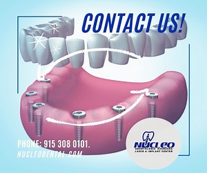 All-on-six is a permanent dental #prosthetic procedure that allows complete recovery of the #dental arch. For more information, contact us and recover your smile. . Phone: 915 308 0101 nucleodental.com . #NucleoDental #ElPasoTx🇺🇸 #CiudadJuarez🇲🇽 #NewMexico #dentalclinicnearme #oralcare #oralhealth #dentaltourism #dentaltourismmexico #dentalimplantsmexico #dentalimplantsjuarez #bestdentalserviceintown✌️🦷 #cosmeticdentistry #dentalservice #orthodonticservice #fullmouthrehabilitation #american