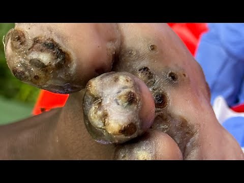 Daniel's right foot WHOLE JIGGERS - see full video @riseupsociety.net