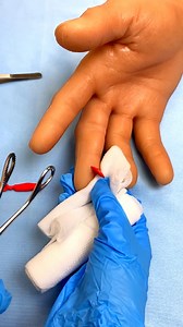 9.9K views · 15 reactions | Strange object in hand gets removed quickly  | Kelly Cook | Facebook