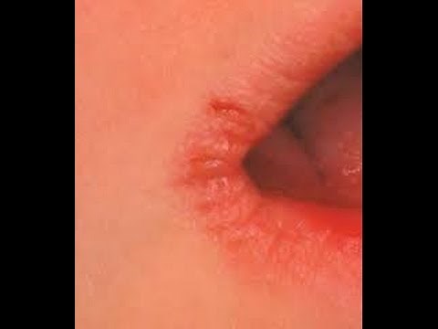 Cracked Lip Corners Treatment | Angular Cheilitis