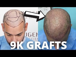 My Final Hair Transplant Journey (Over 9k Total FUE Grafts)
