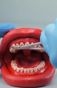 39K views · 72 reactions | The Complete Process of Getting Braces Explained | FoodGasmic | Facebook