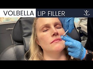 Long-Lasting Volbella Lip Filler
