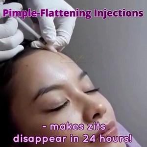 3 comments | We offer different solutions to acne: - Plasma Facial for Acne - Laser Genesis - Pimple-Flattening Injections - PDT / PhotoTherapy - Anti-Acne Peel - Acne ElectroSurgery Get help from our doctor when choosing from Skin Philosophie's wide range of medical-grade treatments for acne. | Skin Philosophie by Dr. Kyla Talens | Facebook