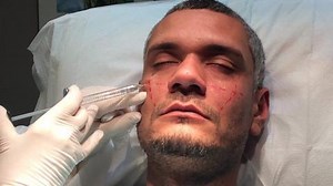 Facial Contouring Using Fillers for Men