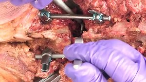 EXPEDIUM VERSE® System - Pedicle Subtraction Osteotomy Closure