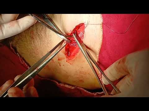 Open appendectomy procedure | step-by-step surgical Guide