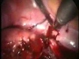Laparoscopic Treatment For Interstitial Ectopic Pregnancy • Video • MEDtube.net