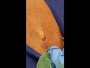 cyst popping p2