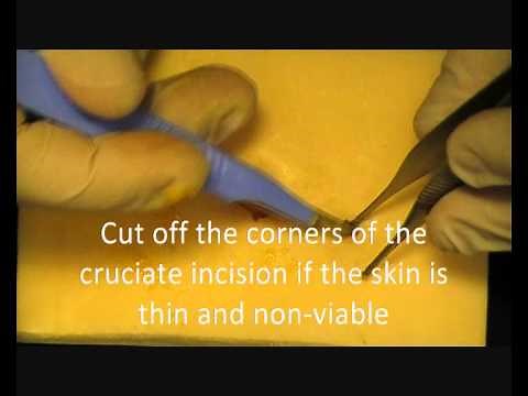 Abscess Incision & Drainage Technique