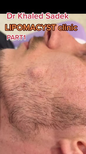 Facial Cyst Extraction and Sebaceous Cyst Removal | Dr. Khaled Sadek