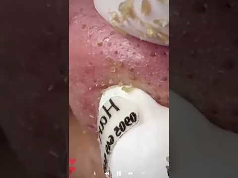 Skincare | Blackheads Removal #733 #tweezers skincare #blackheads blackheads