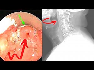 Epiglottitis (Emergency) Symptoms, Causes, Treatment
