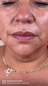 Plasma Lift Upper Lip Treatment✨ My client wanted to target the deep lines above her lip. This treatment will help to minimize wrinkles above her lip and improve skin texture/surface. You can see here we target each wrinkle individually✨ | Plasma Lift Skin Tightening Specialist