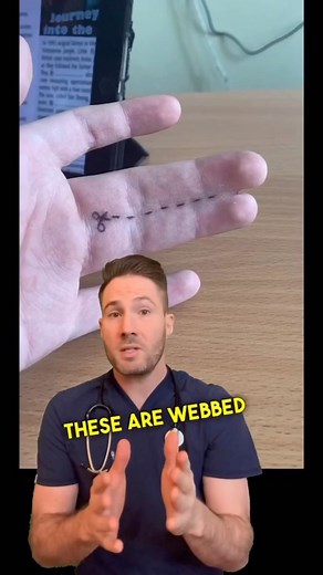 Dr. Joe, M.D. on Instagram: "Webbed fingers, also known as syndactyly, is a condition where two or more fingers are fused together by a membrane of skin and soft tissue. This condition occurs during fetal development when the fingers fail to separate properly. While they may look different from the typical hand, they can still function normally, and people with webbed fingers can typically perform everyday activities without difficulty. In fact, some individuals with webbed fingers may even have