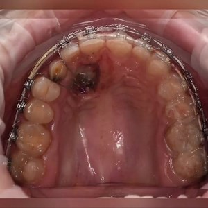 by • @lyapina_ortho ORTHODONTIC TRACTION OF IMPACTED CANINE Successful traction of the upper right canine was achieved. I used all methods to move the tooth into occlusion and get a great result. Unfortunately I couldn't have this case done … 💙💛 #lyapina_ortho #ортодонтхарьков #стоматологхарьков #брекетыхарьков #стоматологияхарьков #ботоксхарьков ##dentalphotography #ortho #orthodontics #bracesoff #braceslife #ortodontia #ortholovers #ortholove #dentistryworld #dentistrylove #dentistrystudent 