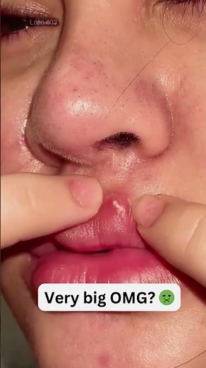 Large Blackheads Extraction Big Cystic Acne Blackheads&Whiteheads Removal Pimple Popping #1087 2026