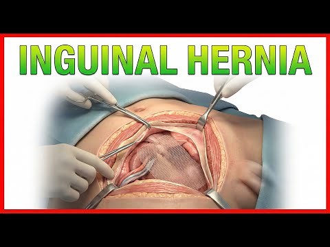 Inguinal Hernia: Indirect Inguinal Hernia, Direct Inguinal Hernia, Treatment: Surgery