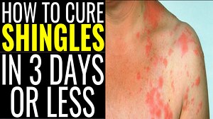 3 comments | These tips, which you can do at home, can help ease the pain and itch from shingles. | How to and Health | Facebook