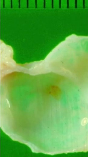 Ganglion Cyst - #Pathology #shorts