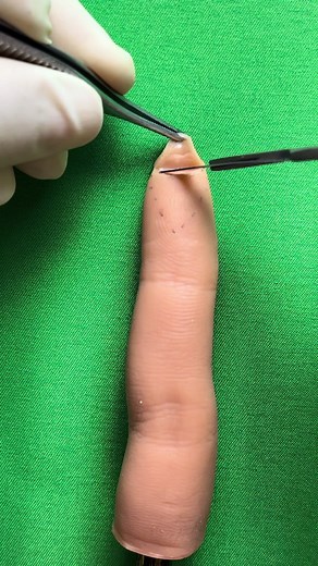 V-Y plasty for fingertip amputation (incision)