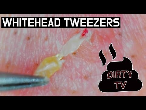 #7 Pull out White heads with Tweezers/ Whiteheads Close up 300X - Blackheads white heads Removal