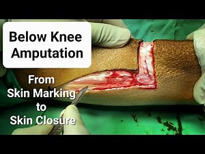 Below Knee Amputation | Step by Step | Video Based Learning - Dr Tayyab Riaz Ch