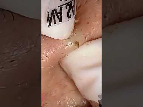 Skincare | Blackheads Removal #794 #tweezers skincare #blackheads blackheads