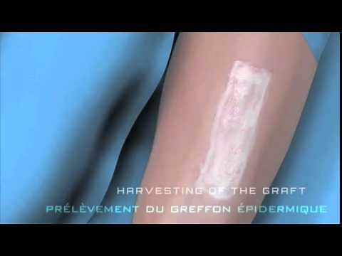 NEVELIA - Dermal Regeneration Process