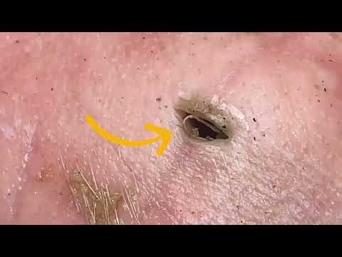 INSIDE THE SKIN SHOCKING PORE EXTRACTION and OIL BUILDUP You’ve NEVER Seen Before - PART 1