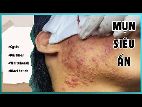 Big Cystic Acne Blackheads Extraction Blackheads & Milia, Whiteheads Removal Pimple Popping