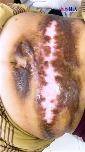 Laser Treatment Explained | Safe & Advanced Skin Care | Dr Suneel Kishore