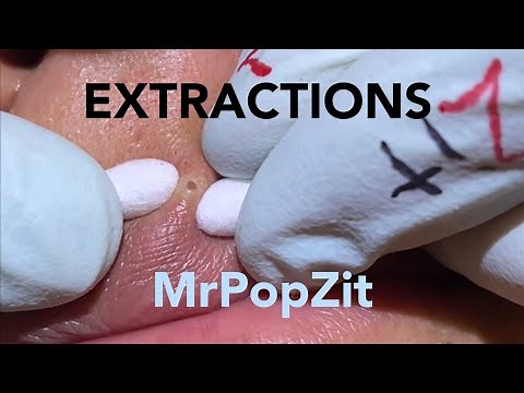 Acne Extractions.Blackheads for days 5. Nothing but the pop.Creamy pore pops. Blackheads,whiteheads