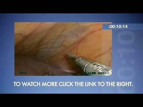 ORLive Express: Convergent Procedure For Atrial Fibrillation