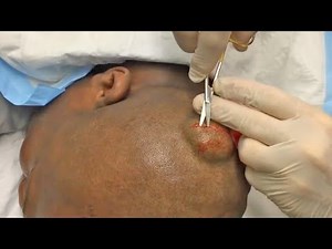 Dr. Gilmore's BANNED Cyst Removal Procedure