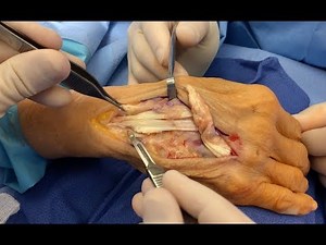 Spontaneous Extensor Tendon Rupture and Repair