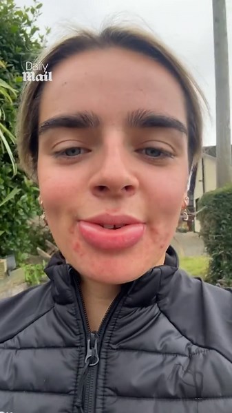Wasp sting leaves woman with HUGE lips