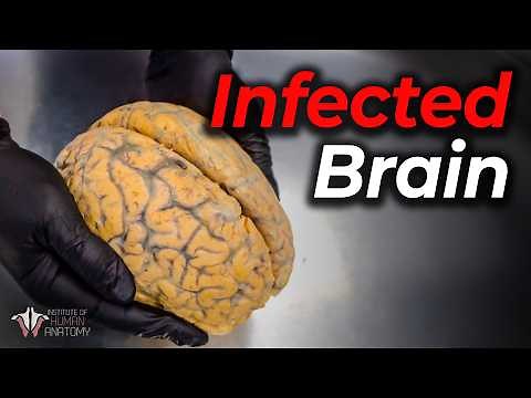 Rabies: One of the Most Deadly Viruses