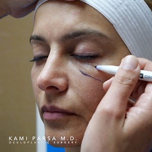 21 reactions · 5 comments | If you have a patient with malar edema do...