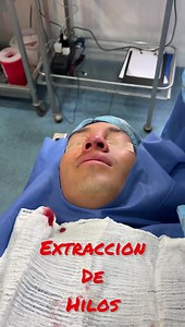 ✨Nuestro paciente se realizó una #cirugiaplastica #rinoplastia con extracción de hilos tensores el cual ya le estaba causando una infección en su nariz, que esperas para realizar tus sueños realidad ✨con #holamauricio lo hacemos #realidad comunícate al #0990916911📱📲 y obtén tu consulta gratis | Hola Mauricio Cirugías Plásticas