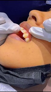 Color matching for single central incisor 🦷 ❤️ | Dr CK