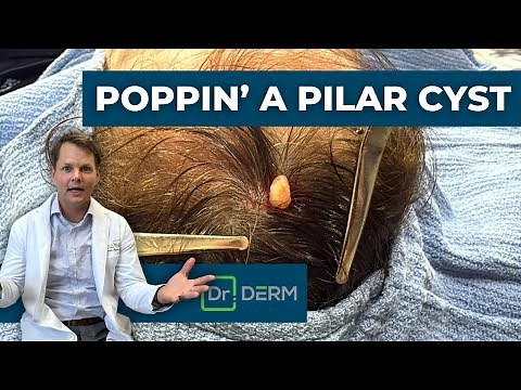 Poppin' a Pilar Cyst | Dr. Derm