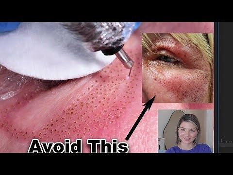 Plasma Pen Treatment, watch before you DO IT !!!