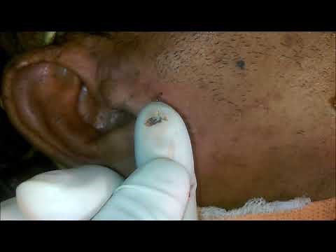 Something On Ear Lobe