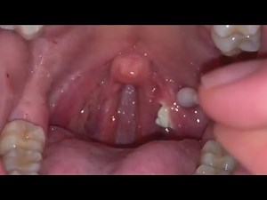 How to remove Tonsil Stones? | 4 different cases | Tonsilloliths