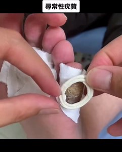 Effective Verruca Plantaris Removal Methods