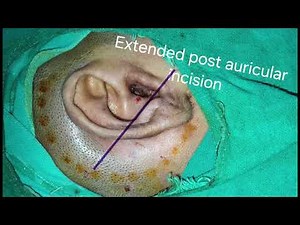 Subtotal petrosectomy in a dead ear/blind sac closure #bestentdoctor #ear #mastoidectomy