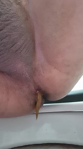 Quick diarrhea that ends with stinky fart